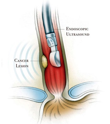 Endoscopic Ultrasound