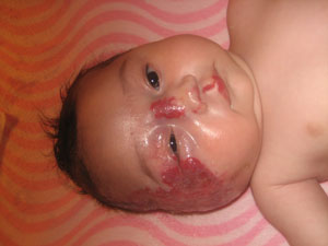 Thea Baby with Hemangiomas