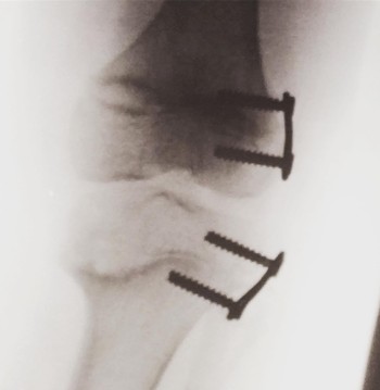Sophia's Leg X-Ray