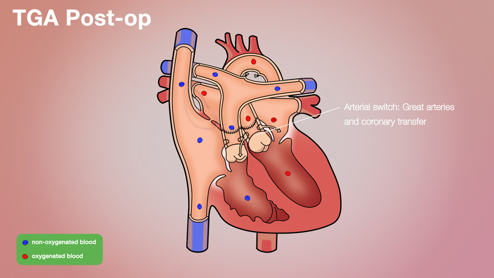 TGA Post-op Anatomical Heart