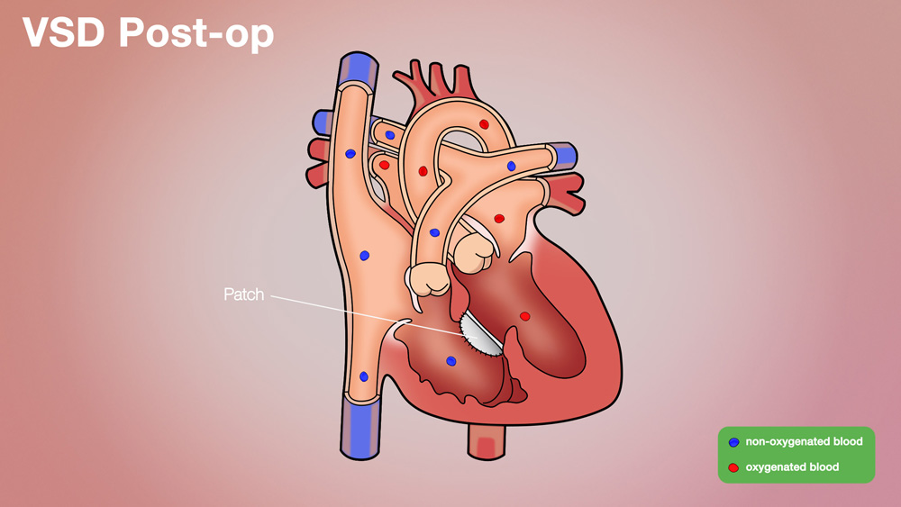 VSD Post-op Anatomical Heart