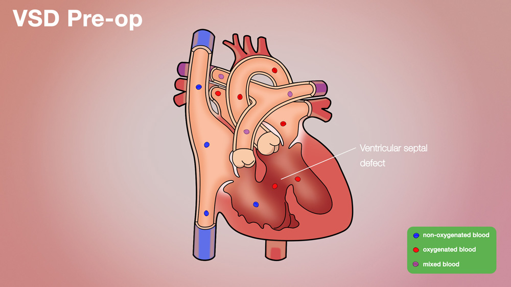 VSD Pre-op Anatomical Heart