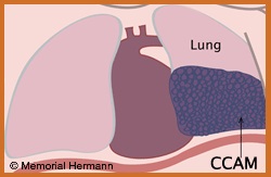 Pediatric Congenital Cystic Adenomatoid Malformation Fetal Lung Illustration