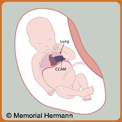 Congenital Cystic Adenomatoid Malformation Fetus Illustration