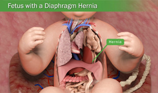 Fetus with congenital diaphragmatic hernia