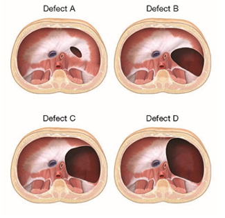Size and severity of diaphragmatic hernia