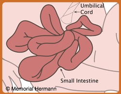Gastroschisis Fetal Intestine Illustration