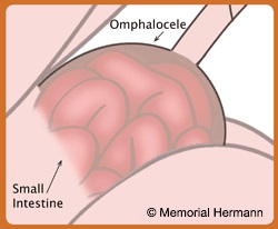 Fetal Omphalocele Intestine Illustration