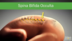 Spina Bifida Memorial Hermann