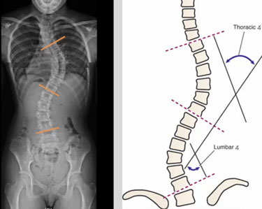 Pediatric Scoliosis X Ray Evaluation and Illustration