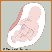 Pediatric Urinary Tract Obstruction Fetus Option Two
