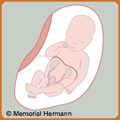 Pediatric Urinary Tract Obstruction Fetus Option Three