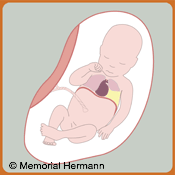 Pleural Effusion Fetus Illustration