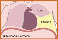 Pleural Effusion Lungs Illustration