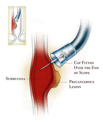 Endoscopic Mucosal Resection Procedure
