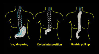 Types of Esophagectomy