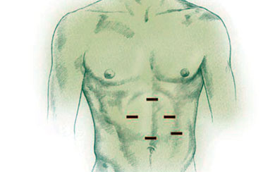 Laparoscopic Heller Myotomy Procedure