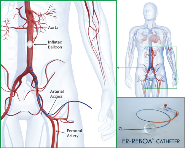 ER-REBOA Catheter